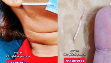 Photo of 泰女喝鱼汤误吞2cm鱼刺 2周后喉咙被穿破速动刀取出
