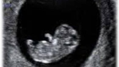 Photo of 孕妈怀三胞胎竟剩一胎 网惊: 宿儺出世了?