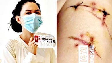 Photo of 遭陌生男挟持 女子身中20刀 “庆幸有隆胸” 挡下致命一击