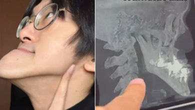 Photo of 世界最长下巴YTR！X光照揭“骨骼惊人真相” 医生也看傻