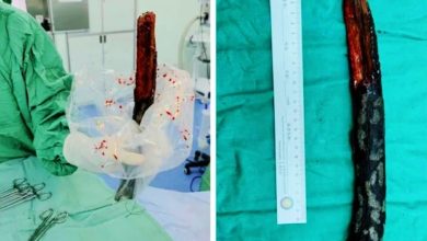 Photo of 枯树枝跌落竟插入男子颈部直达胸腔 医生：万幸避过所有大血管