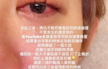 Photo of 看视频学煮蛋酿爆炸 台女星眼角膜破裂脸烫伤