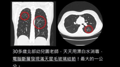 Photo of 幼儿园老师从不抽烟 肺部满布肺结节 竟是漂白水害的