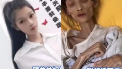 Photo of 罹患胃萎缩！27岁正妹“45公斤变17公斤”暴瘦成骷髅精