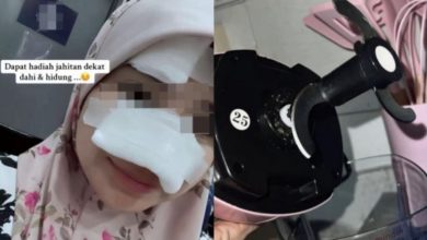 Photo of 搅拌机刀片飞脱割脸 妇女额鼻缝11针