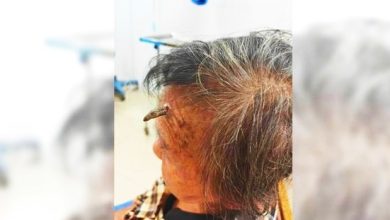 Photo of 98岁老人额头长角！嫌麻烦“自己剪掉”后急送医