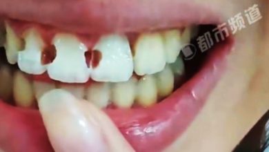 Photo of 5年牙套竟换来8颗蛀牙！医生一听她的刷牙方式直摇头