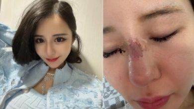 Photo of 日本网美赴韩整形 鼻樑化脓3个月不敢出门