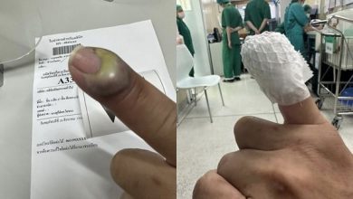Photo of 被猫抓伤险截肢!宠物美容师“手指整块化脓”