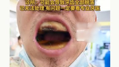 Photo of 男网购材料自行补牙 医生惊呼:口腔长出“烤年糕”