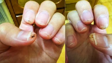 Photo of 女子做美甲10指皆感染病毒疣 医震惊：第一次看到