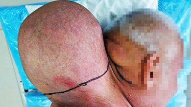 Photo of 涂药膏16年都无效 俄男颈部肿瘤如头般大