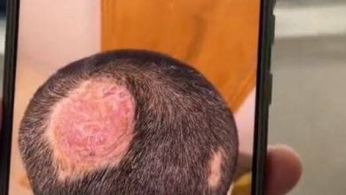 Photo of 男童头长脓癣永远秃了！元凶竟是“一宠物”