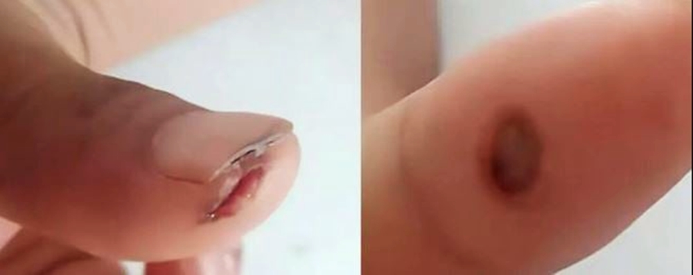 男子右手食指和大拇指被烧伤。