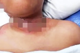 Photo of 充电线缠项链起火! 男童脸和颈部烧伤