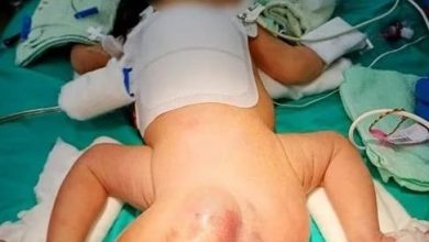 Photo of 女婴出生臀部带16公分大肉球 医师：先天性尾骶骨畸胎瘤