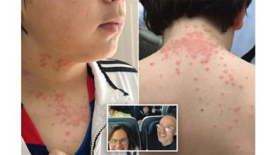 Photo of 飞机上有臭虫!  一家四口被咬到 发炎斑点索赔81万
