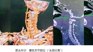 Photo of 广州6旬翁头颈分离 医生用“妙招”救回