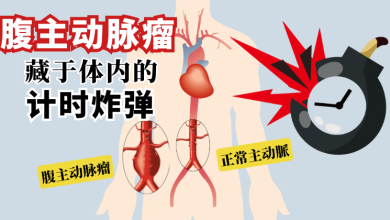 Photo of 【腹主动脉瘤专题】腹主动脉瘤 藏于体内的计时炸弹