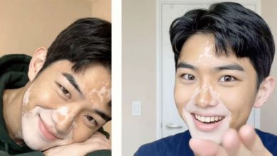 Photo of 白癜风男自信不掩饰 “我的皮肤是地图”获赞