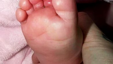Photo of 女婴脚趾被头发紧缠 血流受阻险截肢
