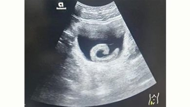 Photo of 信网络偏方! 水蛭塞入尿道 男剧痛求医