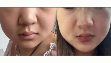 Photo of 以为吃胖了! 24岁女体重激增29KG 全身肿胀竟是尿毒症