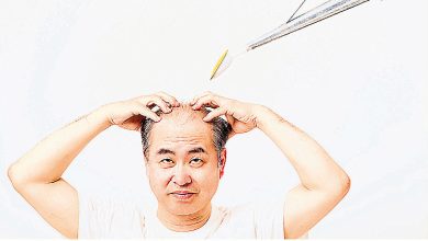 Photo of 每周3针灸救M秃 错过黄金期恐全秃