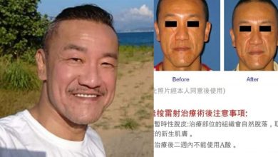 Photo of 医美照打马赛克仍被识破 陈为民高EQ回应网笑翻