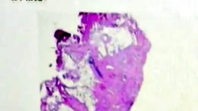 Photo of 长年吸爸爸二手烟 13岁女生患胃癌晚期