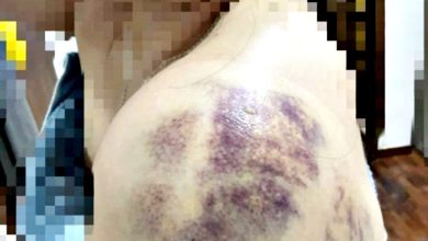 Photo of 单亲妈慘遭男友家暴 報案竟揭他是通缉犯