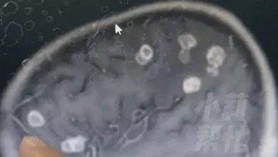 Photo of 6岁女孩大扫除 脑子被“啃”20多个洞！