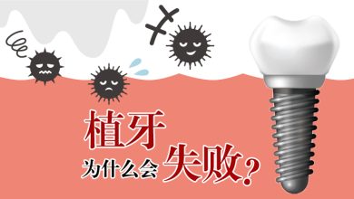 Photo of 【植牙专题】植牙为什么会失败？