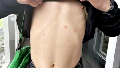 Photo of 入住五星级酒店 男孩全身现红疹