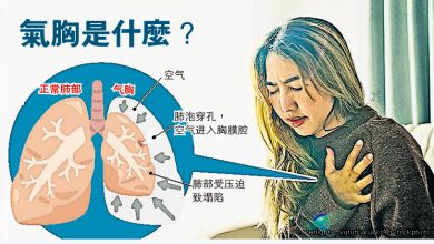 Photo of 气胸复发率逾5成 微创手术可降至4%