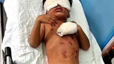 Photo of 玩爆竹炸伤手脚 4岁男童送院