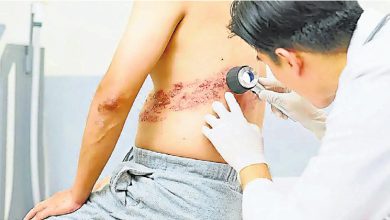 Photo of 生蛇敏感3差异 痛后红疹黄金72小时
