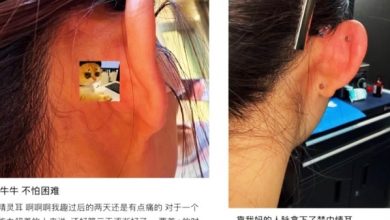 Photo of “精灵耳”整形代价惨重 上海女子打一针终身面瘫