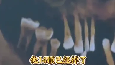 Photo of 男子长期刷牙出血 掉14颗后拔光剩牙