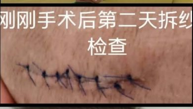 Photo of 1岁儿头部受伤缝8针 母亲报警查保姆