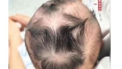 Photo of 越多越聪明？ 男童罕见长9头旋引热议 专家：无关智商