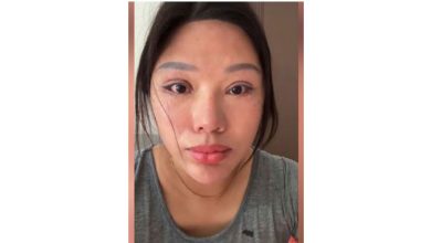 Photo of 女割完双眼皮合不上  : 睡觉也要睁著眼