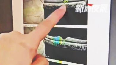 Photo of 直视太阳10分钟“养眼”?男子视力降至0.4 永久损伤不可逆