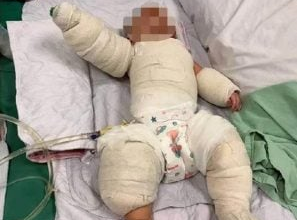 Photo of 5个月大男婴误拉电饭锅电线 遭热水严重烫伤动5小时植皮手术