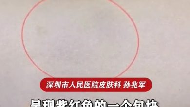 Photo of 以为手臂长瘤 手术取出两尾10公分活虫 医生：毛骨悚然