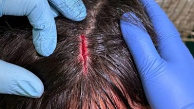 Photo of 食阁招牌坠下砸中10岁童头部! 男童:以为自己要死掉
