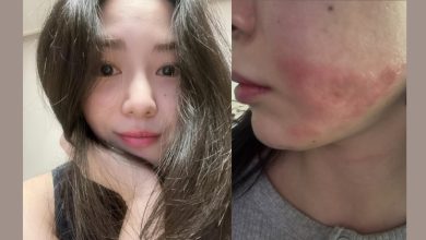 Photo of 医美脸部惨遭烫伤 权珉娥讨公道反被院长提告