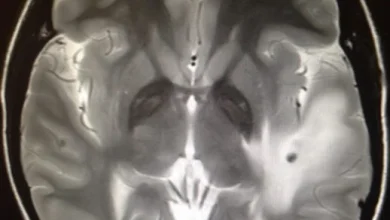 Photo of 在印度疑误食含虫卵食物  英女脑部感染38条寄生虫