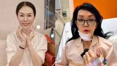 Photo of 患睡眠呼吸中止症险猝死 江梦蕾舌下植刺激器续命