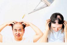 Photo of 雄性秃斑秃休止期脱发 治疗方式各不同